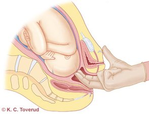 livmorhals&aring;pningen