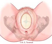 trykkf&oslash;lelse under f&oslash;dsel