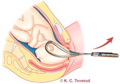 Birth using forceps