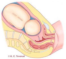 Picture of the fetal bed towards the end of the pregnancy