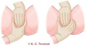  Midwife supports the tissue of the abdomen during childbirth