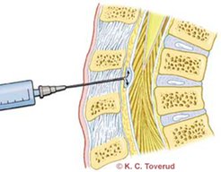 epidural