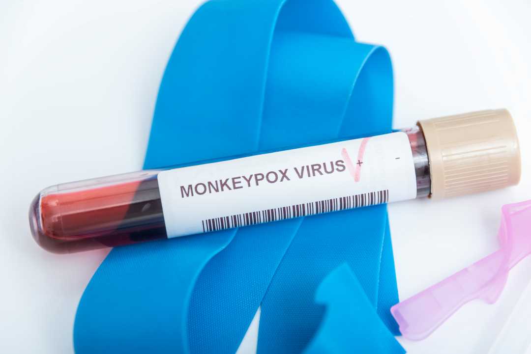 Nærbilde av reagensglass merket Monkey pox.